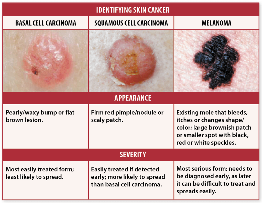 enjoy the sun but take note of these skin cancer signs